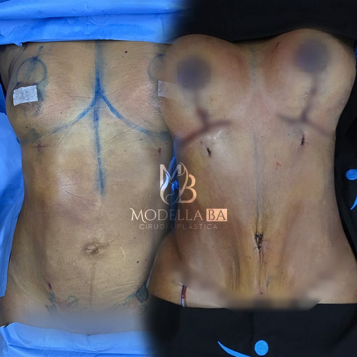 ABDOMINO PLASTIA, MAS MASTOPEXIA