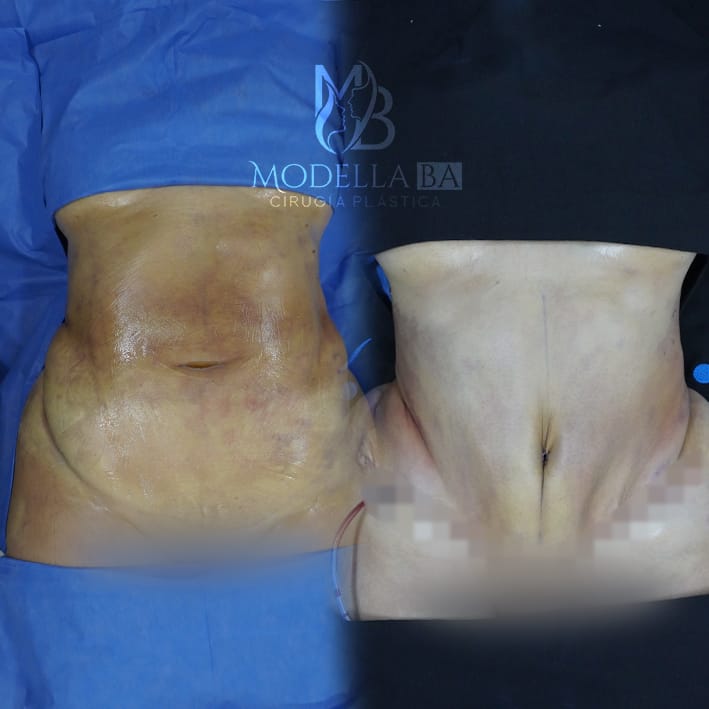 ABDOMINOPLASTIA 2