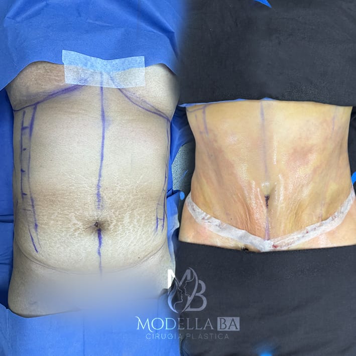 ABDOMINOPLASTIA