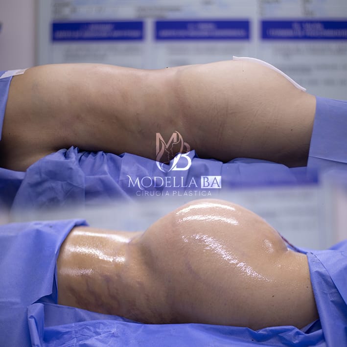 GLUTEOPLASTIA 2