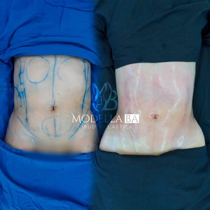 LIPOESCULTURA