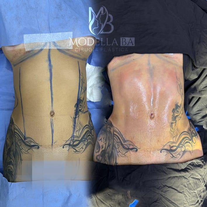 LIPOESCULTURA 2
