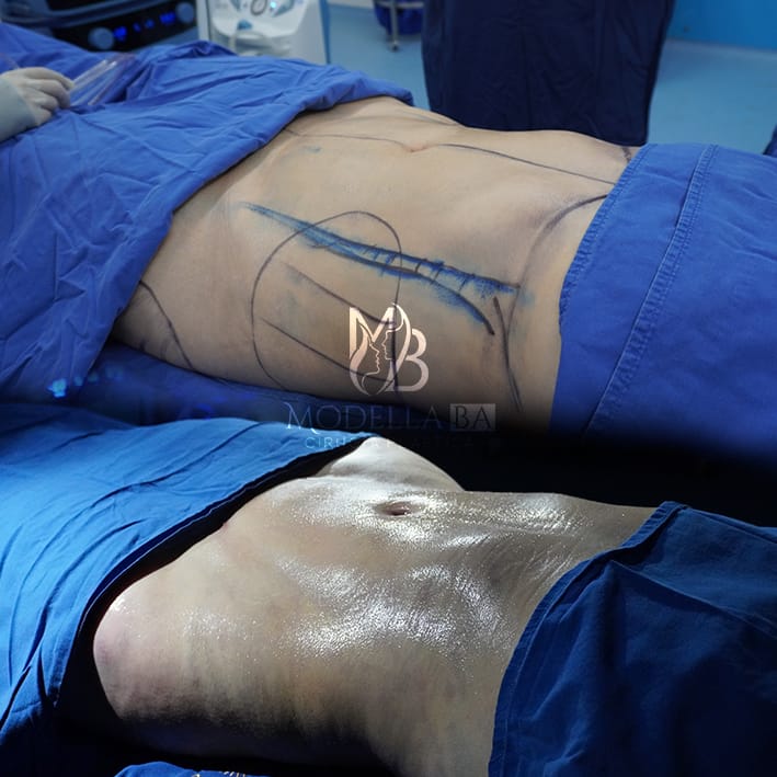 LIPOESCULTURA 3