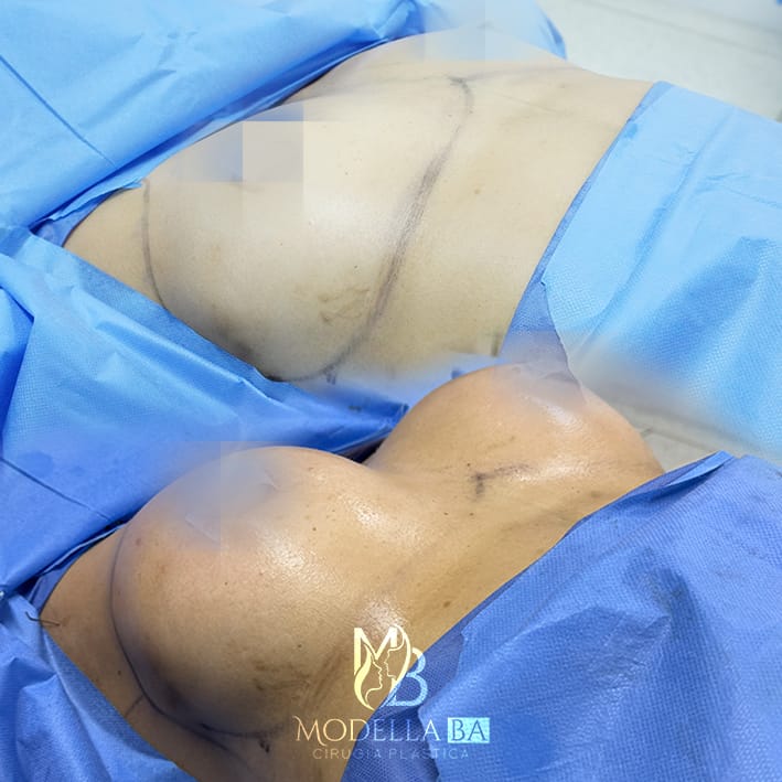 MAMOPLASTIA DE AUMENTO 2