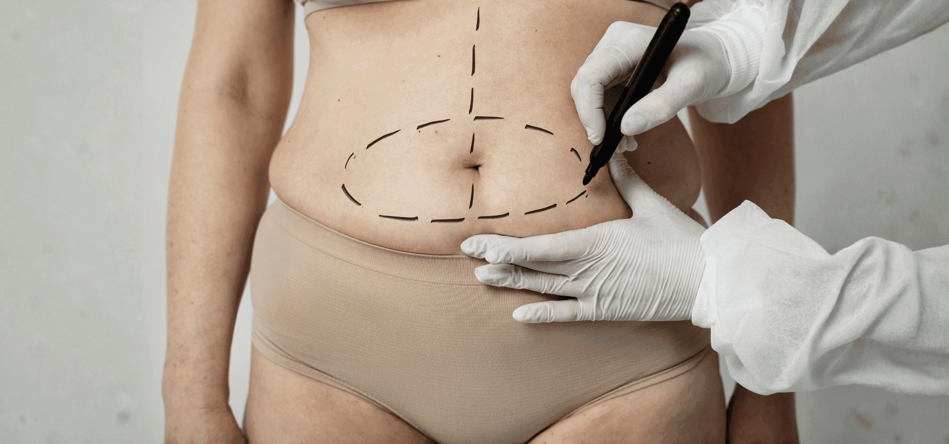 Abdominoplastia